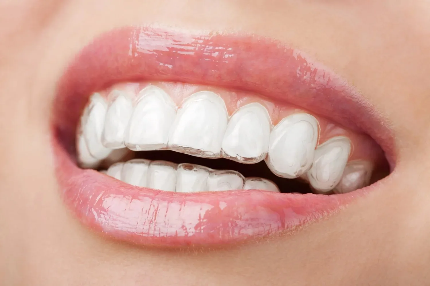 A person smiling while wearing clear aligners on their upper and lower teeth.